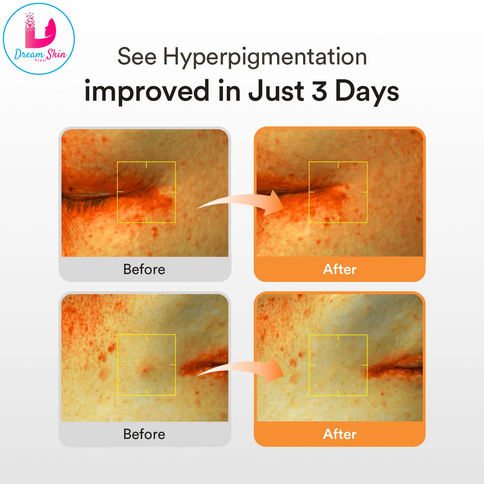 abib glutathione dark spot serum review I finally put the @abib.global Glutathiosome to the test, and heres my honest review! , After just 5 days, the results were clear  my skin is glowing and looks so much healthier!  which crystallizes when exposed to air Abib Glutathiosome Dark Spot Serum